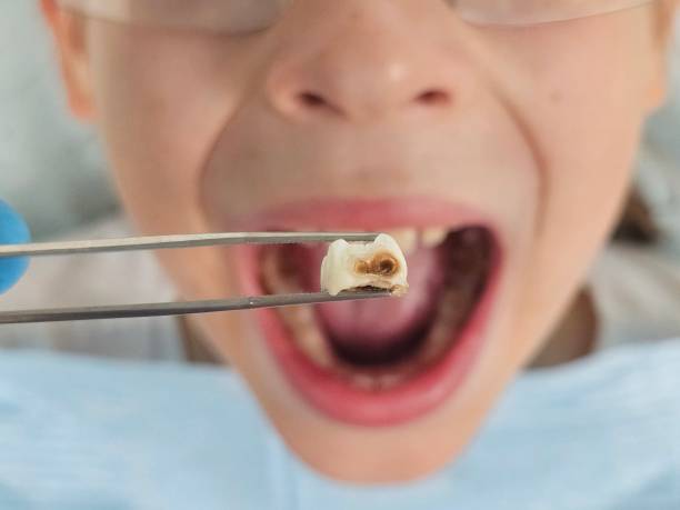 Best Cracked Tooth Emergency Dentist  in Bartonvle, IL